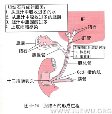 胆结石的食疗法